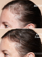 Before & After Using Anti-Hair Loss Treatment