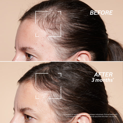 Before & After Using Anti-Hair Loss Treatment