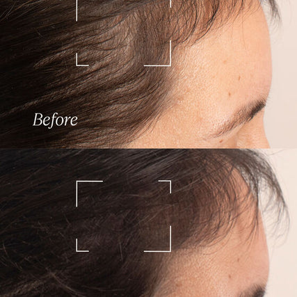 Anti-Hair Loss Treatment_before