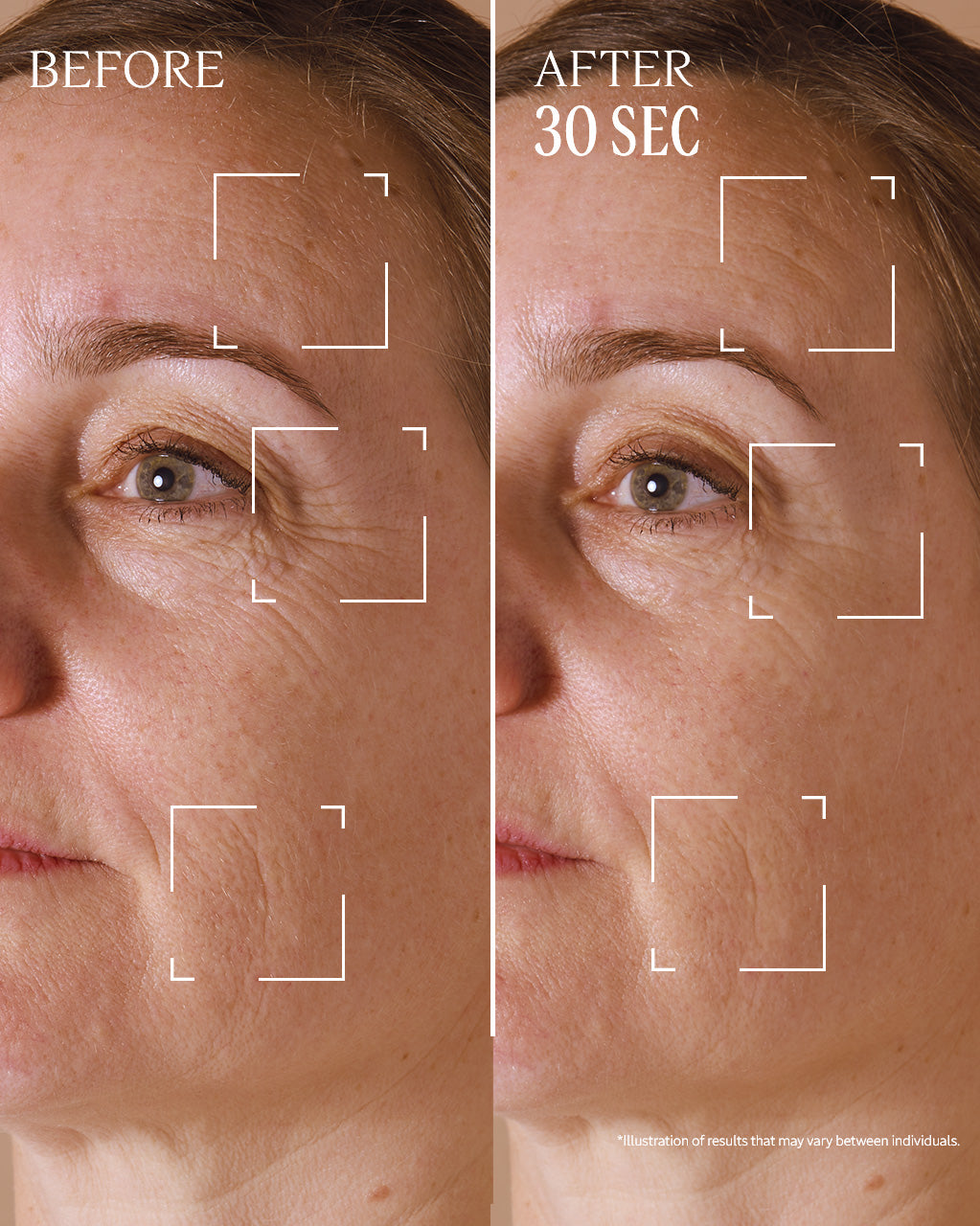 Two pictures of a woman ' s face before and after the procedure - Illustration 5